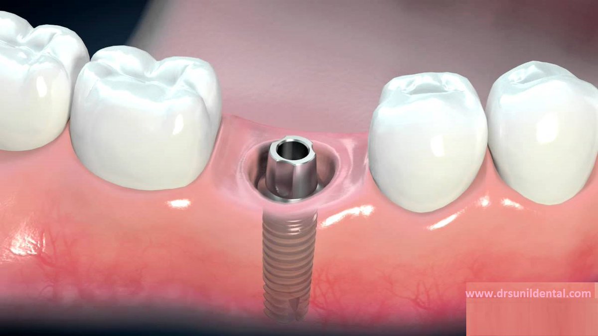 Импланты без коронок фото. Имплантация переднего зуба. Импланты без коронок фото. Циркониевая коронка на имплантате. Импланты без коронок фото.