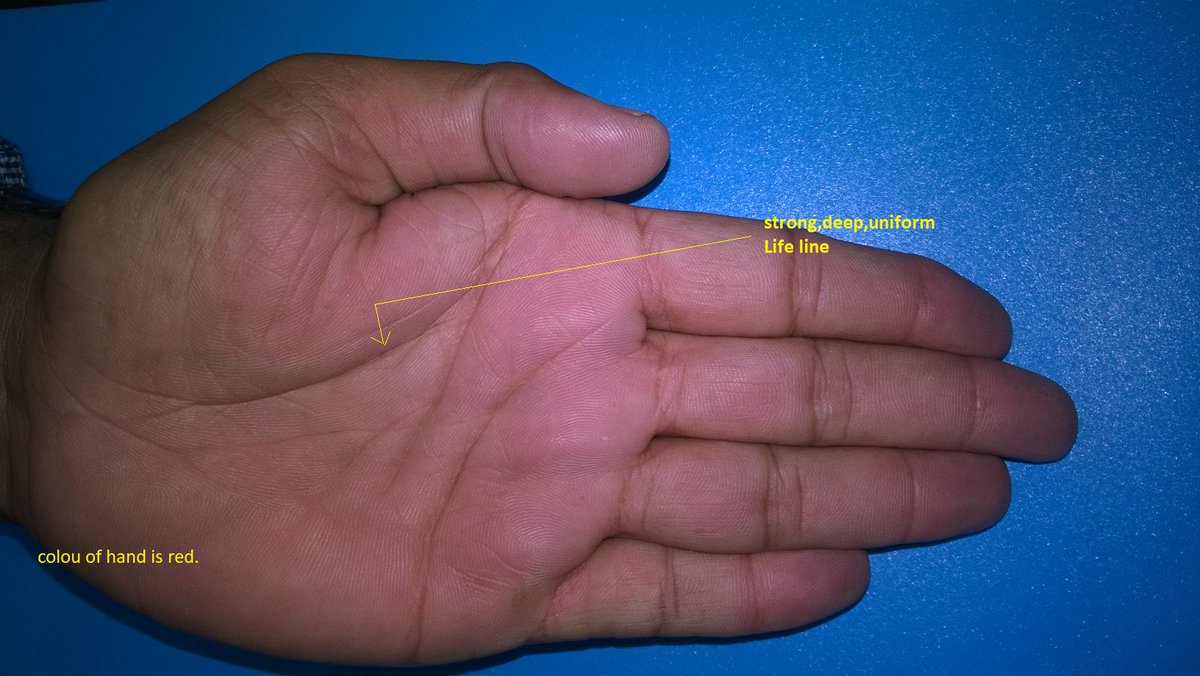 askDrSagar's tweet photo. This is a hand of someone who had recovered from a #death like situation. Regarding #palmistry, the person who has strong life line has strong #will, #resistance, #vitality. That's why managed to make a full recovery to #goodhealth

#Palmreading #astrology #ayurveda https://t.co/8gV9kfsbtJ