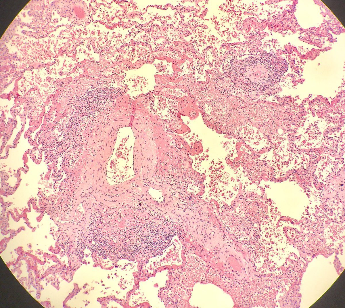 seattlequinns's tweet image. Has anyone had experience w/ vasculitis in systemic sarcoidosis? This patient was presumptively diagnosed based on hilar lymphadenopathy - sarcoidosis involving LNs but no definitive granulomas in lungs. Heart and spleen may be involved. #pulmonarypath #pulmpath #sarcoidosis