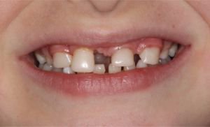 DentistryIQ's tweet photo. Treating young patients with #ectodermal #dysplasia: A #prosthetic dilemma https://t.co/FAzuu6JqRp #dental #dentistry https://t.co/ydKY8tZQfX