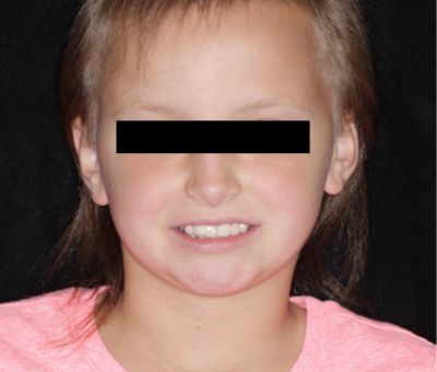 DentistryIQ's tweet photo. Treating young patients with #ectodermal #dysplasia: A #prosthetic dilemma https://t.co/FAzuu6JqRp #dental #dentistry https://t.co/ydKY8tZQfX