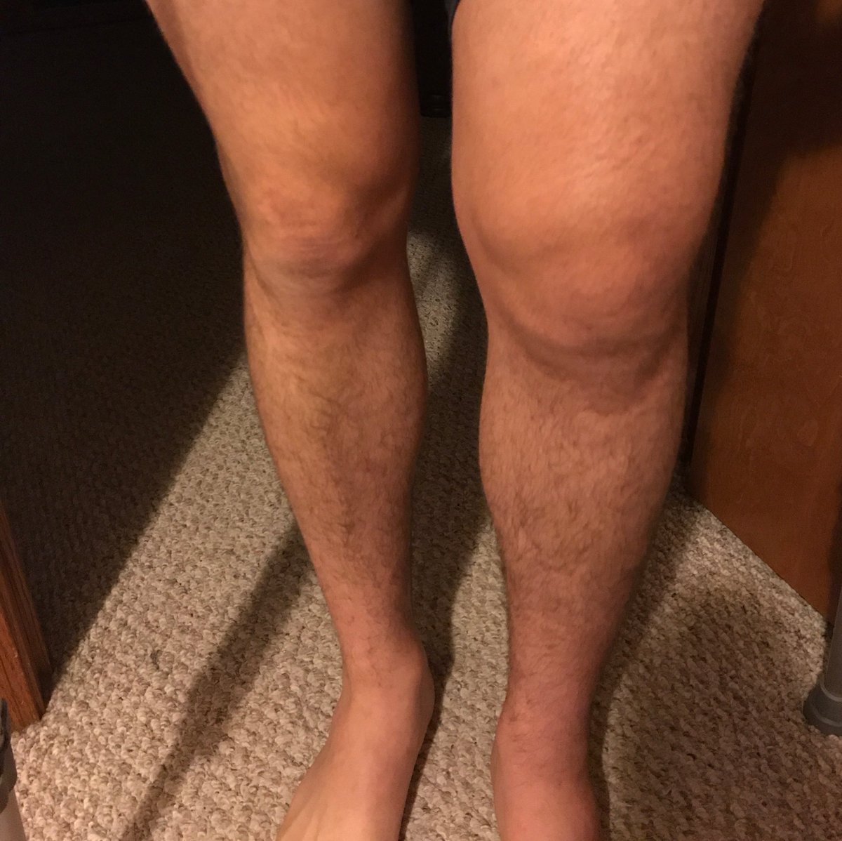 Mad_Plaugher2's tweet photo. Pictures of this terrible injury we have been dealing with since Saturday 😩 look at the lump under his leg in the second picture, to the right of his knee... that's not supposed to be there #mmalife #itfightseries https://t.co/EVX5uQWwYN