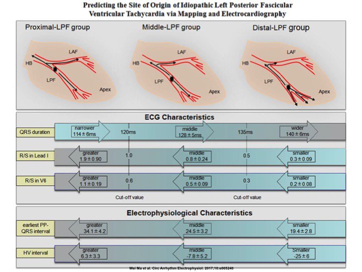 drraviele's tweet photo. The importance of ECG to identify the site of origin in the His-Purkinje system of left posterior fascicular VT: the QRS duration is narrower, and R/S ratio in lead I/V6 tend to be greater with proximal vs. distal origin #CircAE https://t.co/UKnKUyAGeX