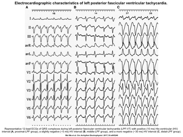 drraviele's tweet photo. The importance of ECG to identify the site of origin in the His-Purkinje system of left posterior fascicular VT: the QRS duration is narrower, and R/S ratio in lead I/V6 tend to be greater with proximal vs. distal origin #CircAE https://t.co/UKnKUyAGeX
