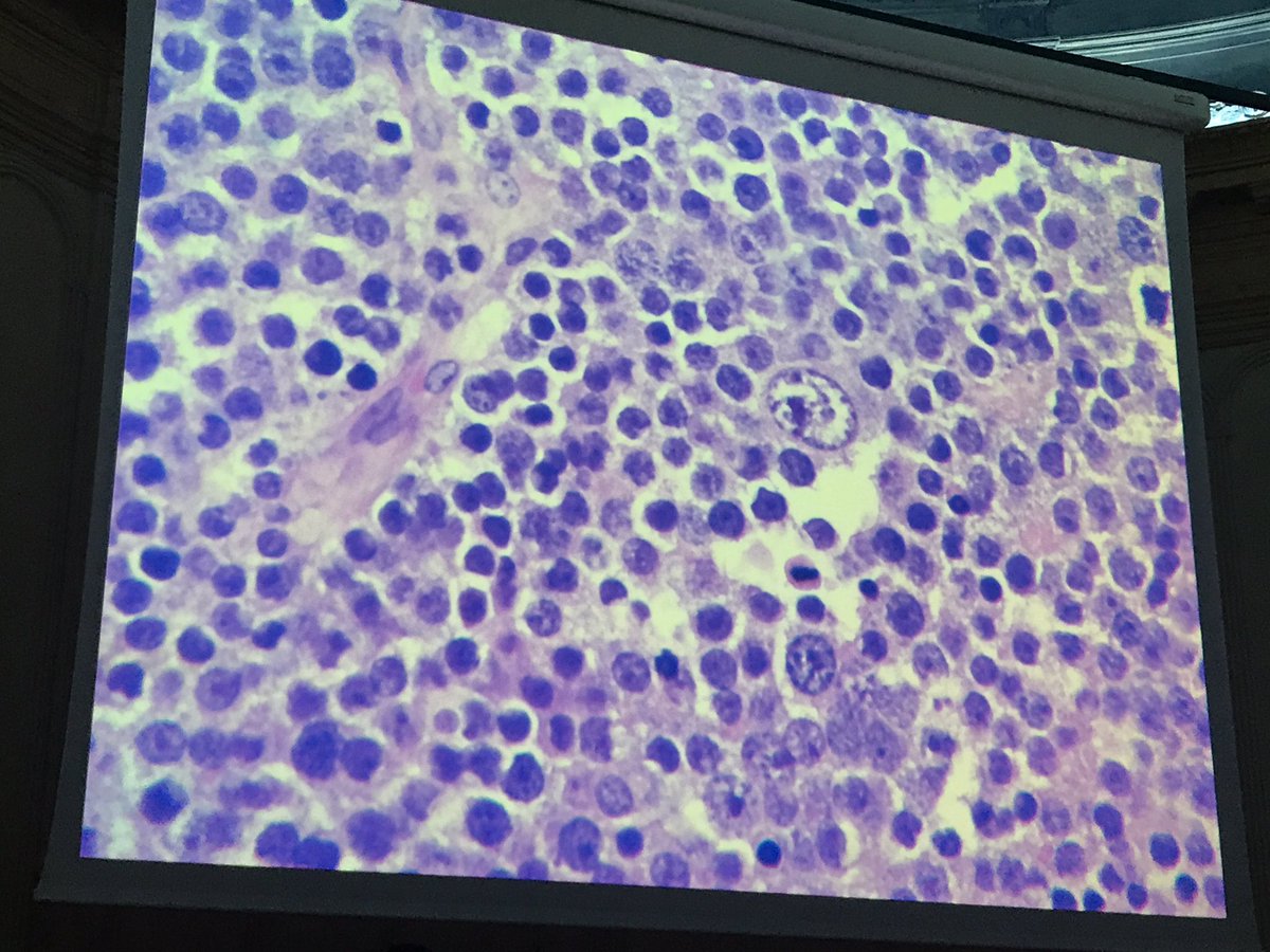 tlabiano's tweet photo. Tumor espermatocítico #GUpath tumor raro con buen pronóstico. Dra L Perez #160RNSEAP https://t.co/2jo46vXPnF