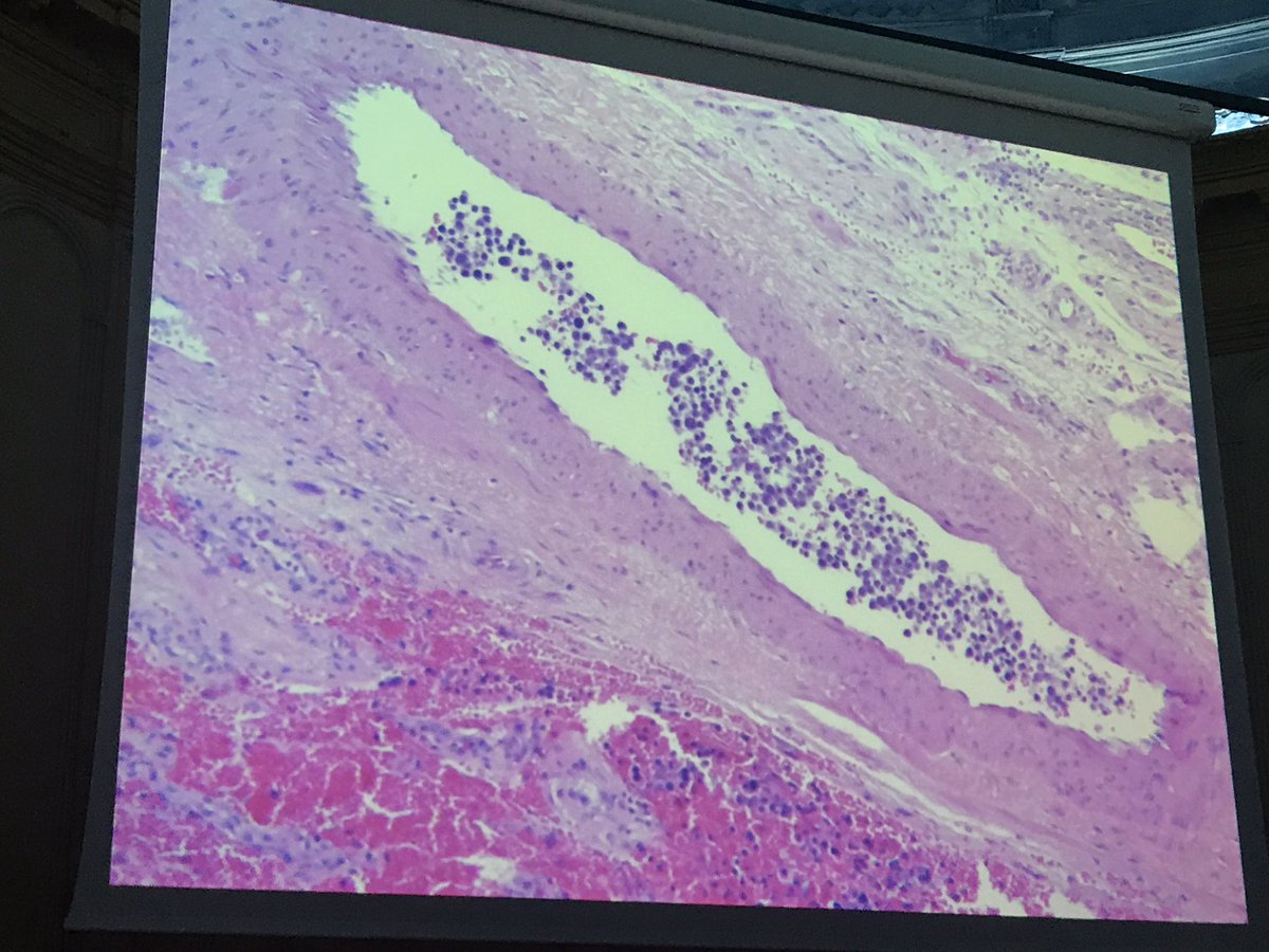 tlabiano's tweet photo. Tumor espermatocítico #GUpath tumor raro con buen pronóstico. Dra L Perez #160RNSEAP https://t.co/2jo46vXPnF