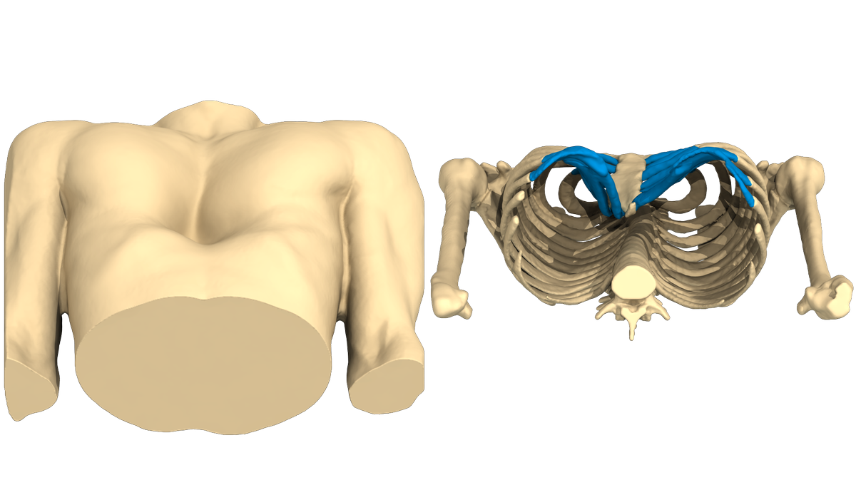 AnatomikM's tweet photo. Pectus Excavatum case of the week.
Strong male, deep asymmetric Pectus Excavatum. 
3D virtual patient's body reconstruction to design 3D custom-made implant. #Pectus #Excavatum #PectusExcavatum https://t.co/ugpp1SRQtJ