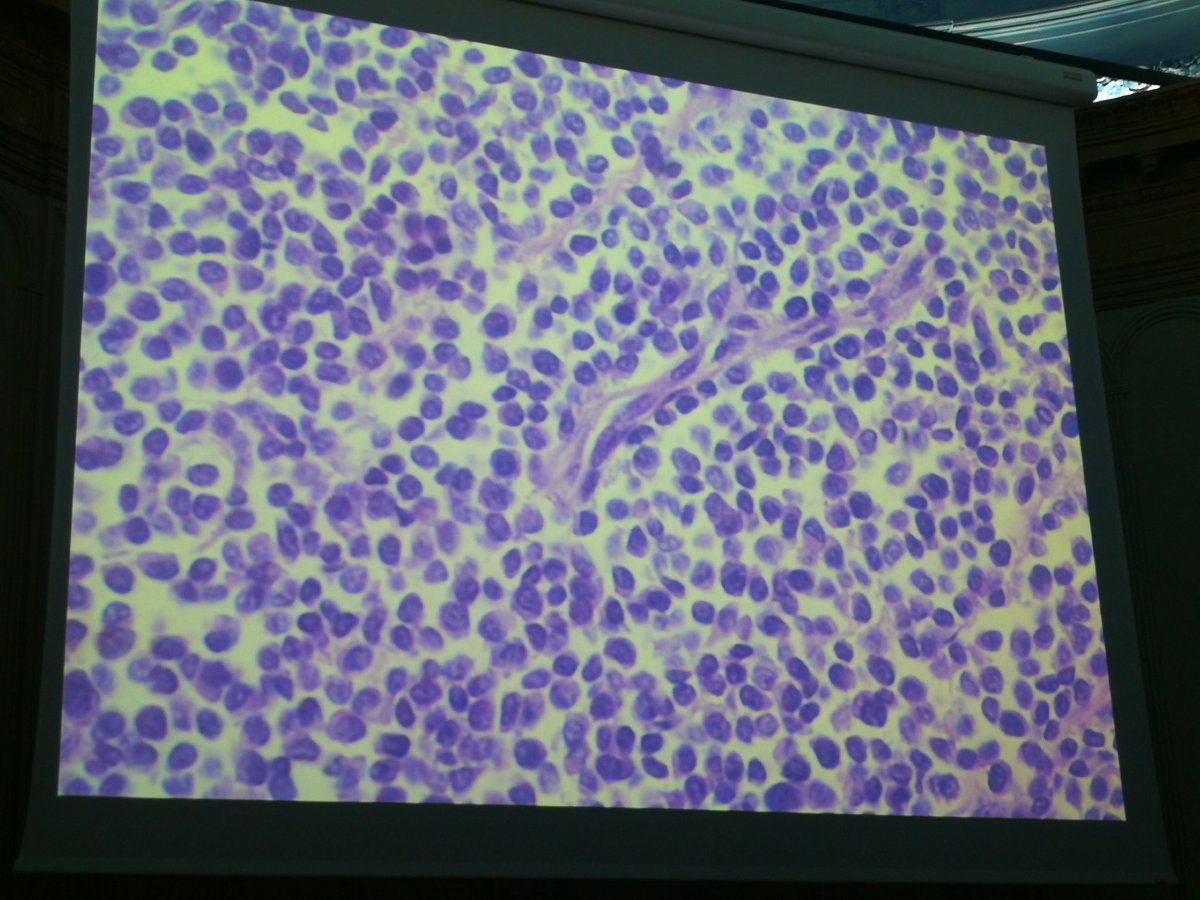 tlabiano's tweet photo. Dra Noelia Barriobero presenta un Caso de AUTOPSIA Ca urotelial plasmocitoide 'imitador de mieloma multiple' #Pathology #160RNSEAP
#GUpath  CD138 CK7 y CD 20 + ecadherina Neg y GATA 3 POSITIVO #HUAraba https://t.co/4AeDH73r88