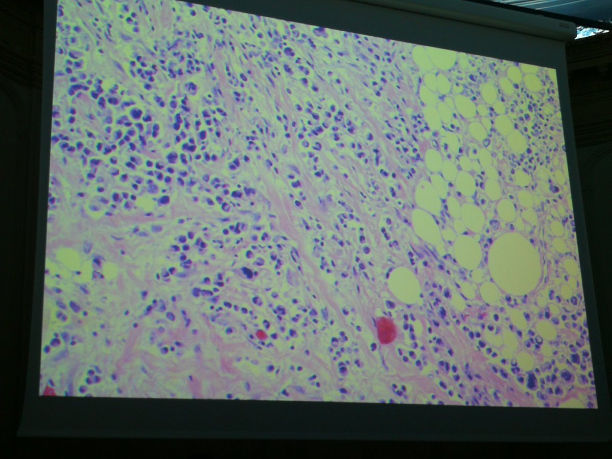 tlabiano's tweet photo. Dra Noelia Barriobero presenta un Caso de AUTOPSIA Ca urotelial plasmocitoide 'imitador de mieloma multiple' #Pathology #160RNSEAP
#GUpath  CD138 CK7 y CD 20 + ecadherina Neg y GATA 3 POSITIVO #HUAraba https://t.co/4AeDH73r88