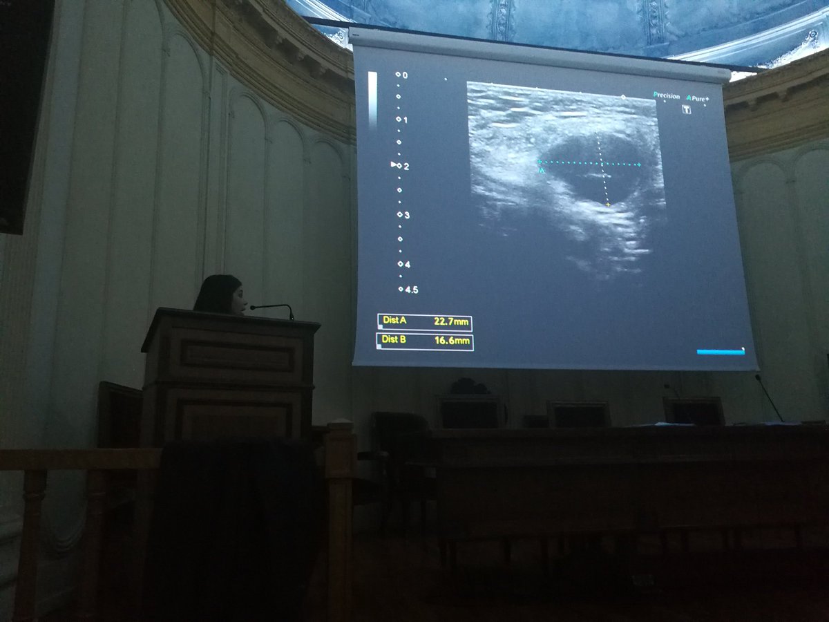 tlabiano's tweet photo. @angelpanizo1 #complejohospitalario Liposarcoma desdiferenciado - amplificación de MDM2 🐟🐡🐬@yessicapau https://t.co/57CSVCl7ZU