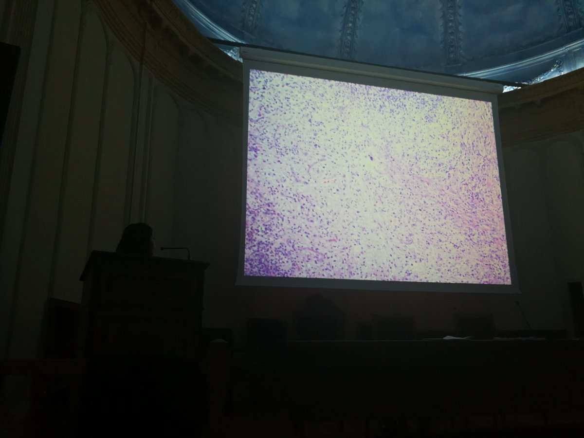 tlabiano's tweet photo. @angelpanizo1 #complejohospitalario Liposarcoma desdiferenciado - amplificación de MDM2 🐟🐡🐬@yessicapau https://t.co/57CSVCl7ZU