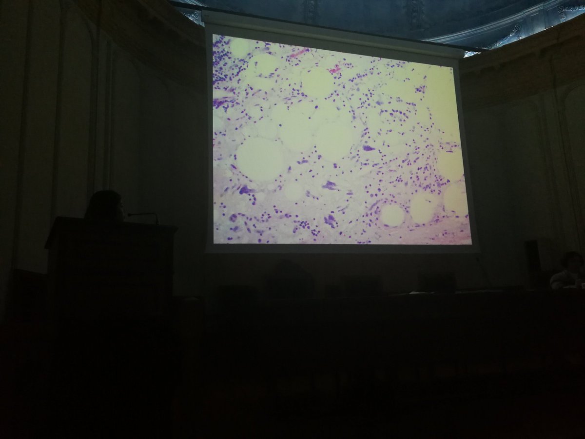 tlabiano's tweet photo. @angelpanizo1 #complejohospitalario Liposarcoma desdiferenciado - amplificación de MDM2 🐟🐡🐬@yessicapau https://t.co/57CSVCl7ZU