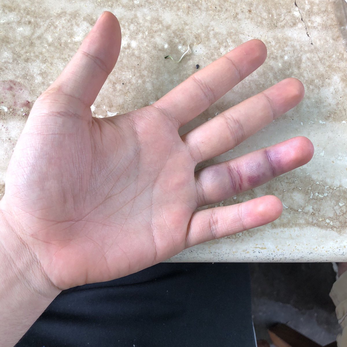 villalobossebas's tweet photo. Después de una escena donde ninguno de los presentes se explica cómo sigo vivo, yo sólo me fracturé un dedo, es todo. Siento como si Dios hubiese hecho un milagro, estoy feliz de que el accidente no haya ido más lejos y esperando recuperarme pronto https://t.co/fa577QJVtM