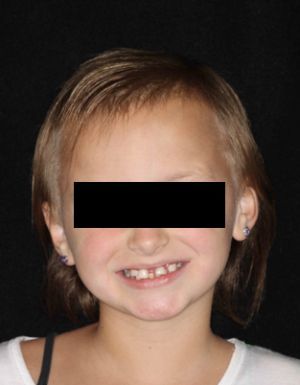 DentistryIQ's tweet photo. Treating young patients with #ectodermal #dysplasia: A #prosthetic dilemma https://t.co/9FSPGNUlox #dental #dentistry https://t.co/LE1hxPn3NX
