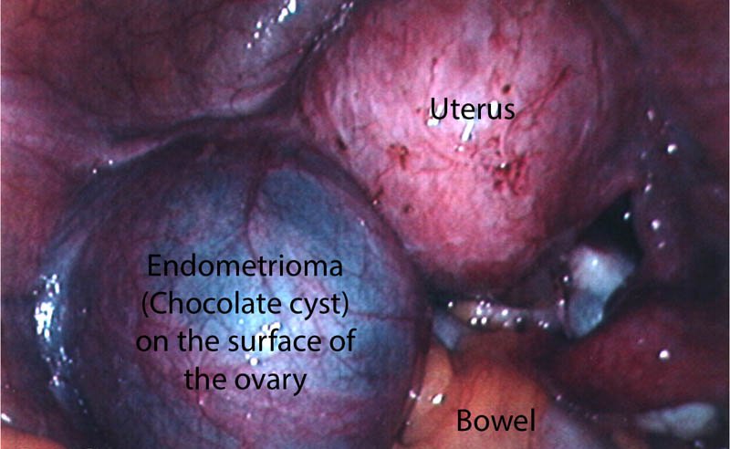 Endometrioma tratamiento