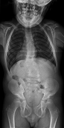 BoneJointJ's tweet photo. Severe #thoracolumbar #kyphosis in #patients with #mucopolysaccharidoses can be effectively treated by #circumferential #arthrodesis https://t.co/jfA0zAS5FR https://t.co/ynUugJf6yc