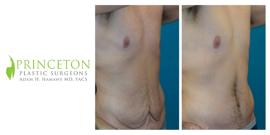 #Weight loss is great, but the extra skin left behind can leave you feeling underwhelmed. This patient underwent a #TummyTuck to get rid of that #ExtraSkin. Click the link to see more of our patient gallery & call 609-385-0330 to learn more. http://ow.ly/ubcI30gXjDa