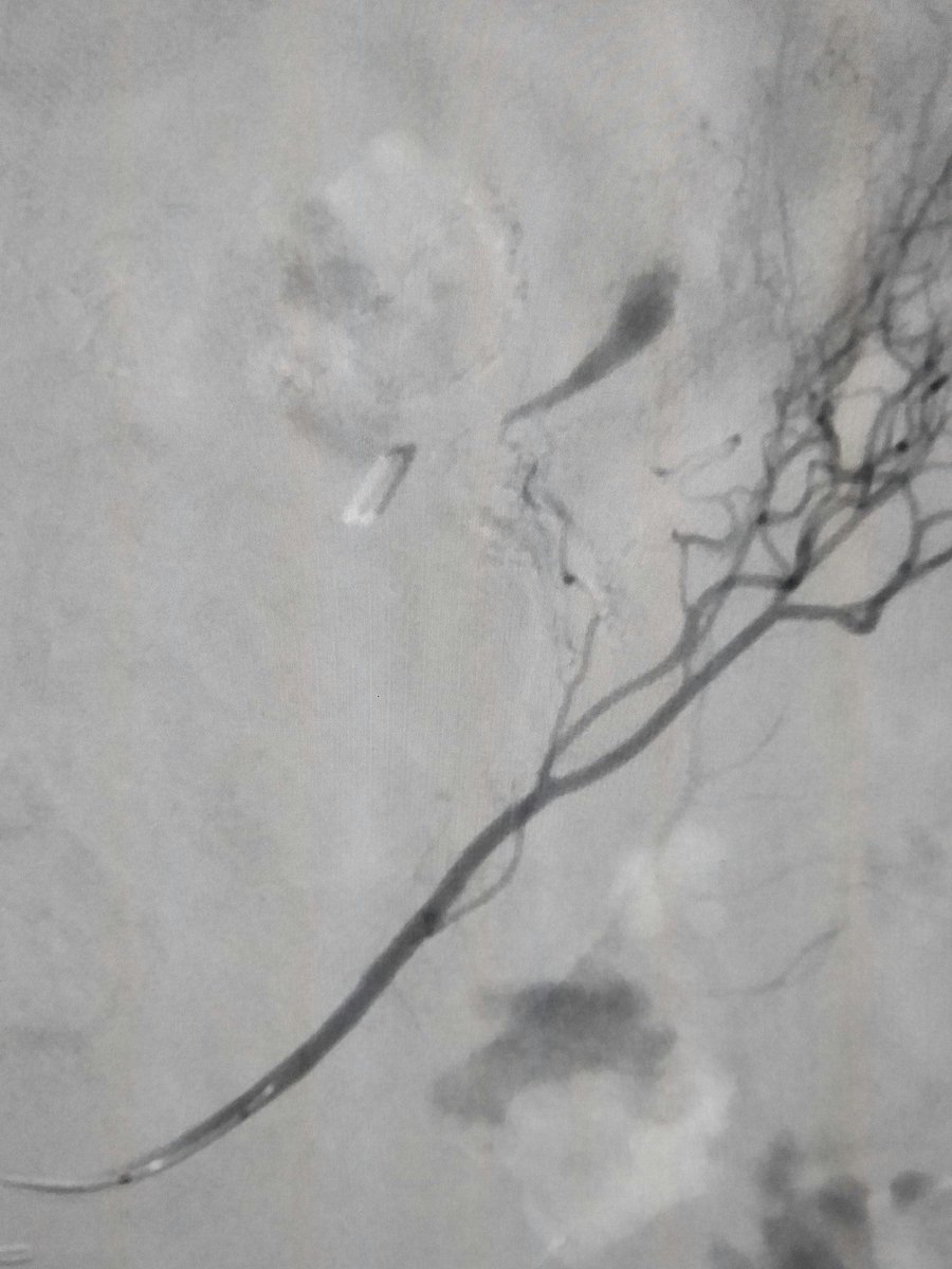 Active jejunal bleed.  Very distorted anatomy post-roux en y gastric bypass.  Swift ninja FTW <a href="/MeritMedical/">Merit Medical</a>