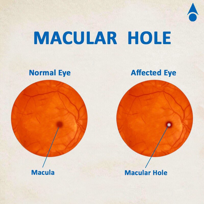 Dr.Agarwals on Twitter "Do you notice grey or black spots in your