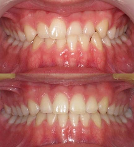 QuickStraightTeeth tweet media