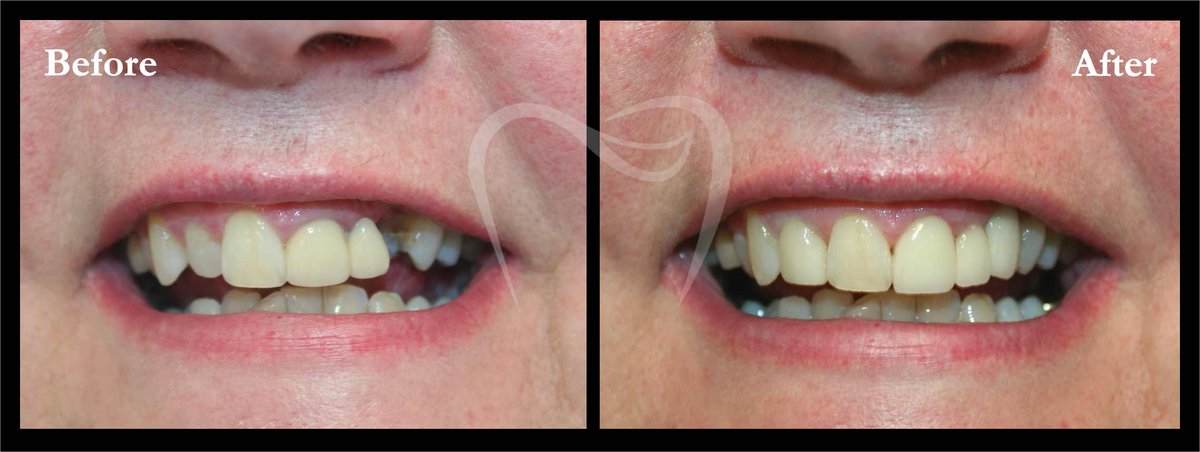 BDSLaboratory's tweet photo. We are dedicated to providing restorations of a superior, private quality at reasonable prices.  #dentalhygiene https://t.co/iELNSkBuF3 https://t.co/HAQby0CVBX