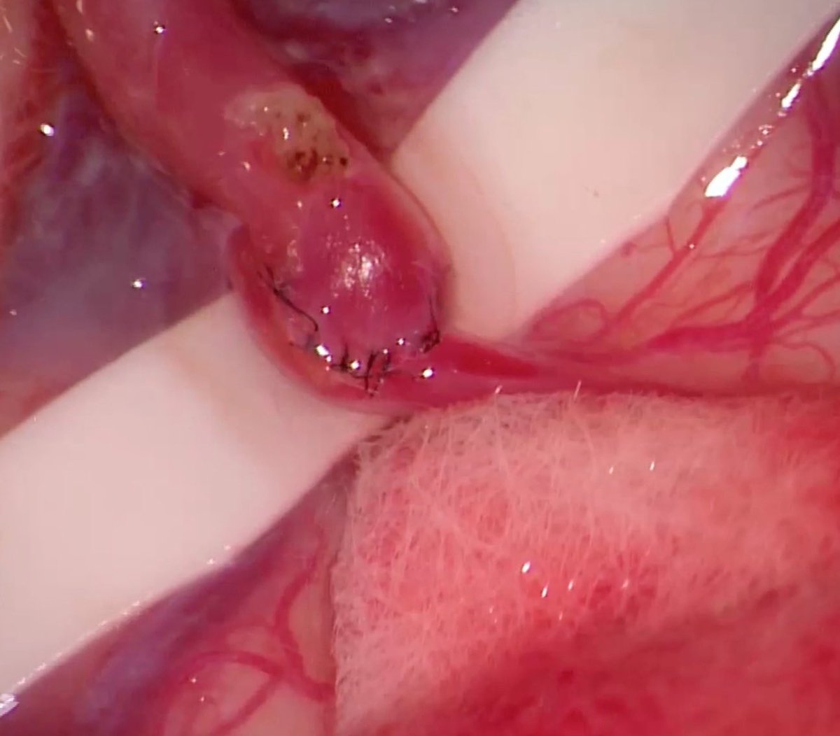 New report from our group in @StLouis_Larib : Another #brain revascularisation option when the STA is not available : The Occipital Artery as an Alternative Donor for Low-Flow Bypass to Anterior Circulation worldneurosurgery.org/article/S1878-…