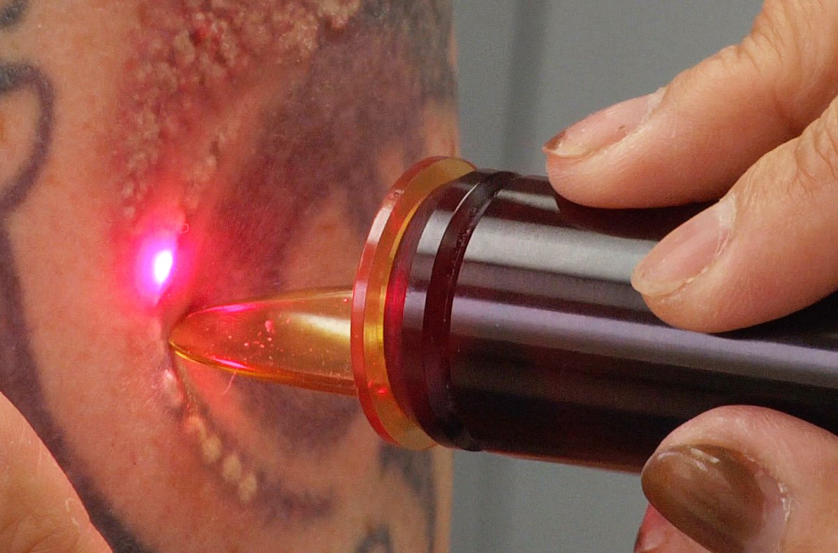 sky_clinic's tweet photo. Tattoo Removal- Are you in your ‘Tattoo Removal’ phase, and wonder what to do and where to go? Our Cosmetologists will help you get rid of the unwanted ink permanently with the state-of-the-art laser technology.
Read More-
 https://t.co/Pm01oZVDKq
#Tattoo #shanghai #skyclinic https://t.co/ihTwCKk2hQ