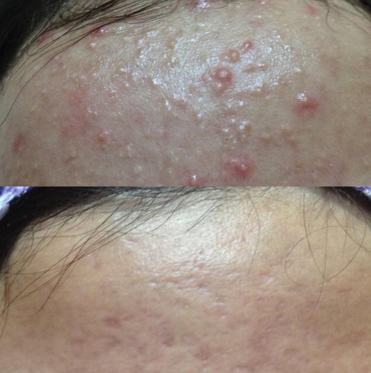 ivanmedgroup's tweet photo. Amazing results on #activeacne after only 3 #Dermapen™ treatments! #acnetreatment #acneremedy https://t.co/gbftlhy1LN