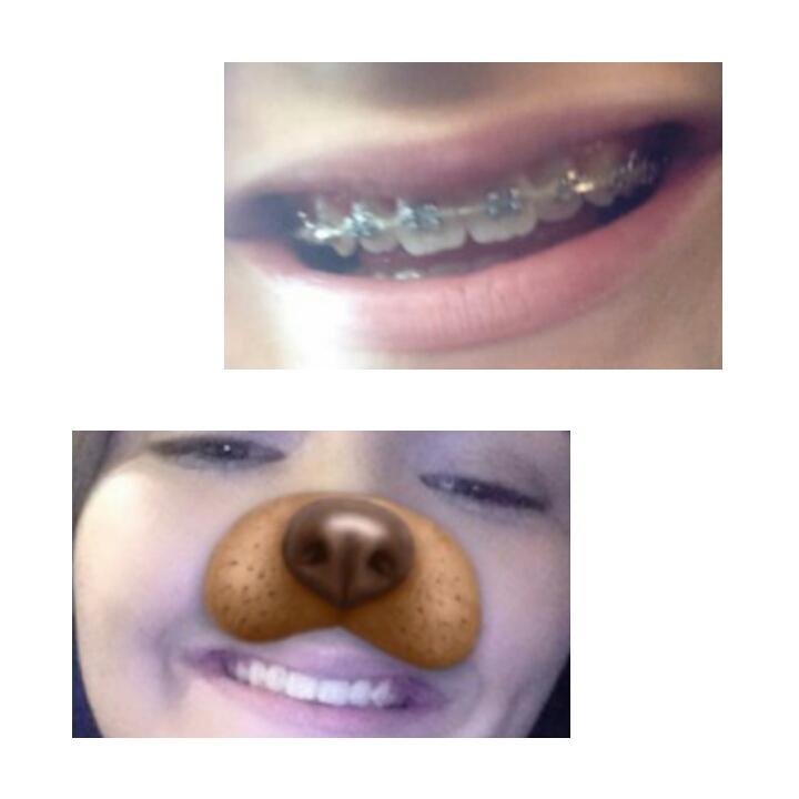 Amazing work by all <a href="/ClevelandOrtho/">ClevelandOrthodontic</a> thank you 😆