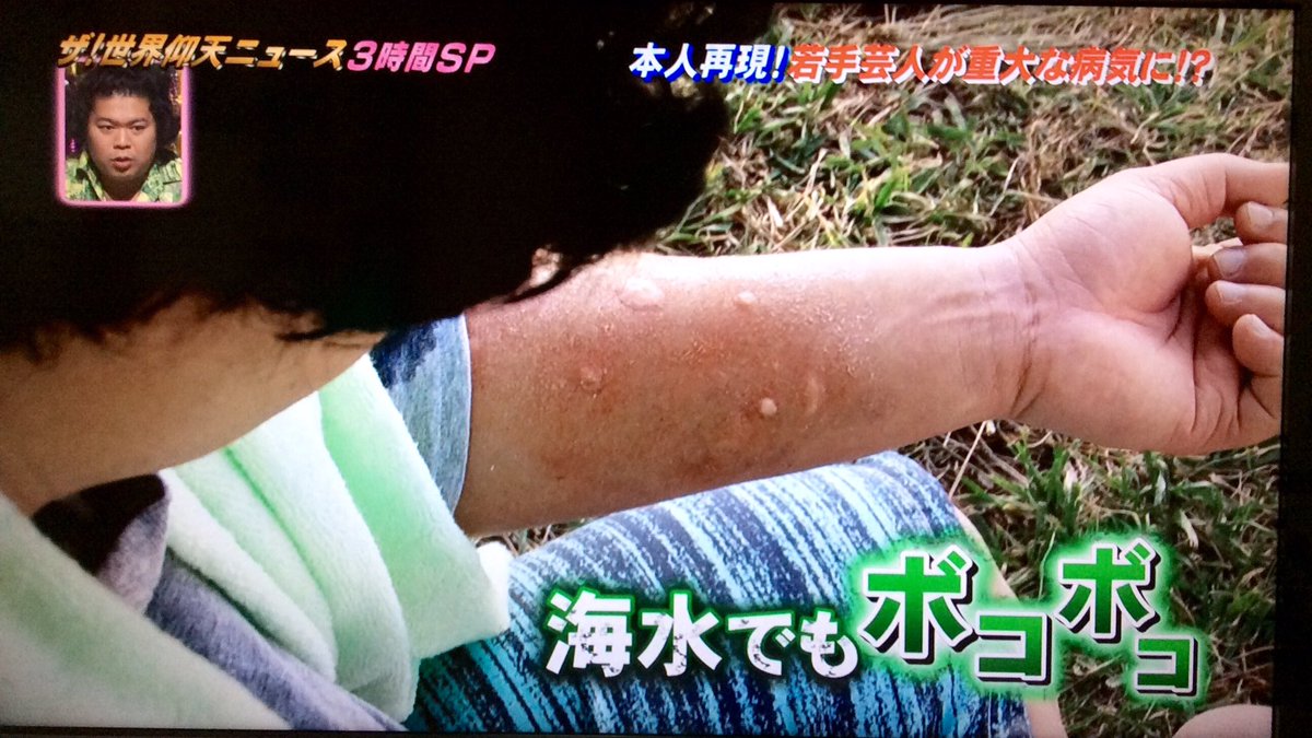 夢浦忍 水アレルギーじゃなくて 雨水や海水に含まれる微生物に反応するアレルギー だったとのことで スタジオは白井さんを非難する空気に 水アレルギーじゃなくても日常生活に支障があるんだから茶化すようなことじゃないと思うが 世界仰天ニュース
