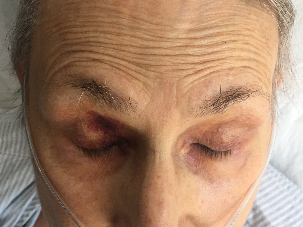 SaurabhSDani's tweet image. @MusaSharkawi @arjmajMD @SarjuGanatra @bcostelloMD @ash71us @purviparwani @AnkurKalraMD @majazayeri @Yanish12 @Dr_Khan @AdiAJoshi #everseenthisbefore ...too common or we are diagnosing it more? # echofirst #CMR #ECGfirst# bloodtest# ACC jeopardy