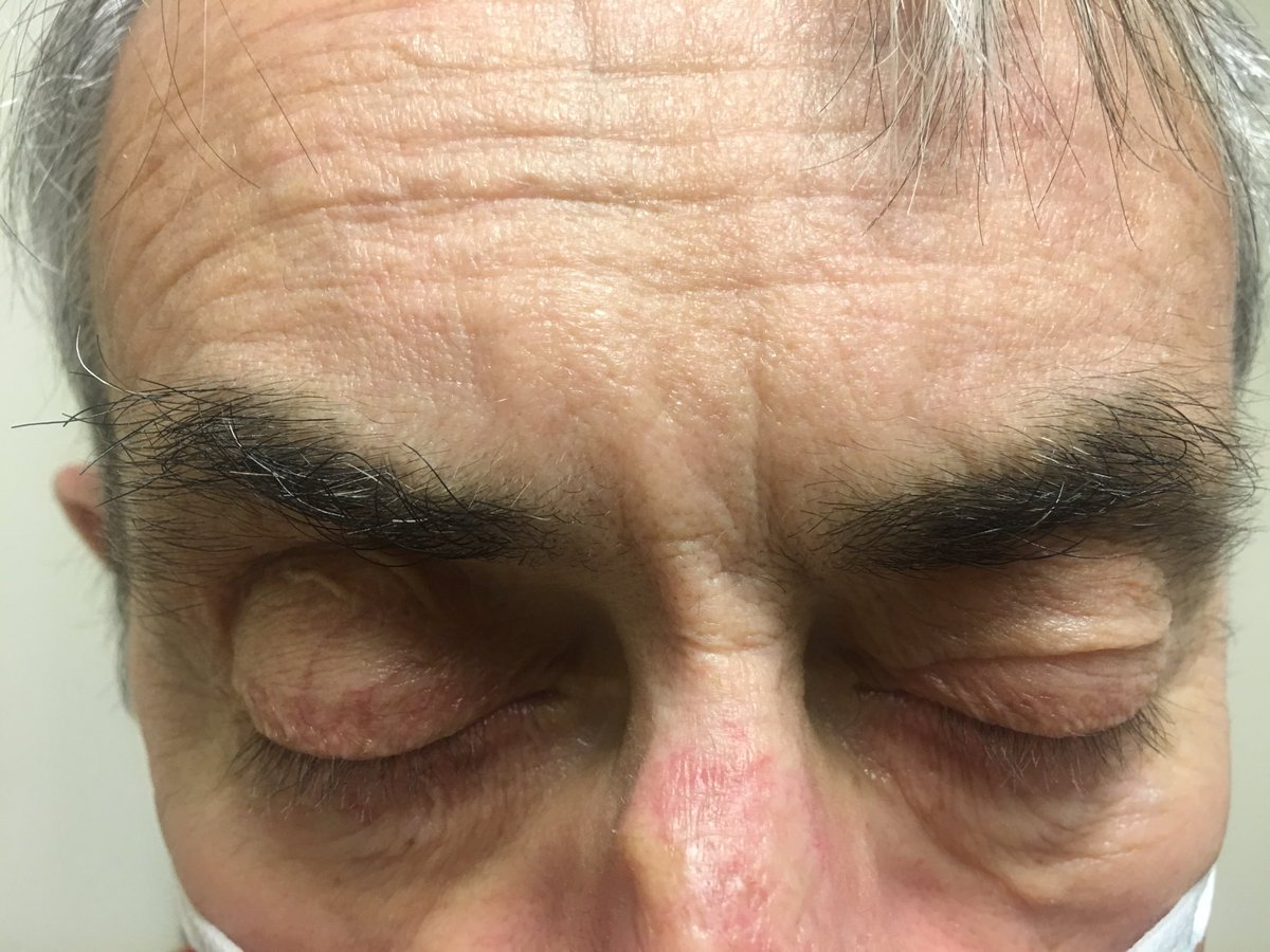 SaurabhSDani's tweet image. @MusaSharkawi @arjmajMD @SarjuGanatra @bcostelloMD @ash71us @purviparwani @AnkurKalraMD @majazayeri @Yanish12 @Dr_Khan @AdiAJoshi #everseenthisbefore ...too common or we are diagnosing it more? # echofirst #CMR #ECGfirst# bloodtest# ACC jeopardy