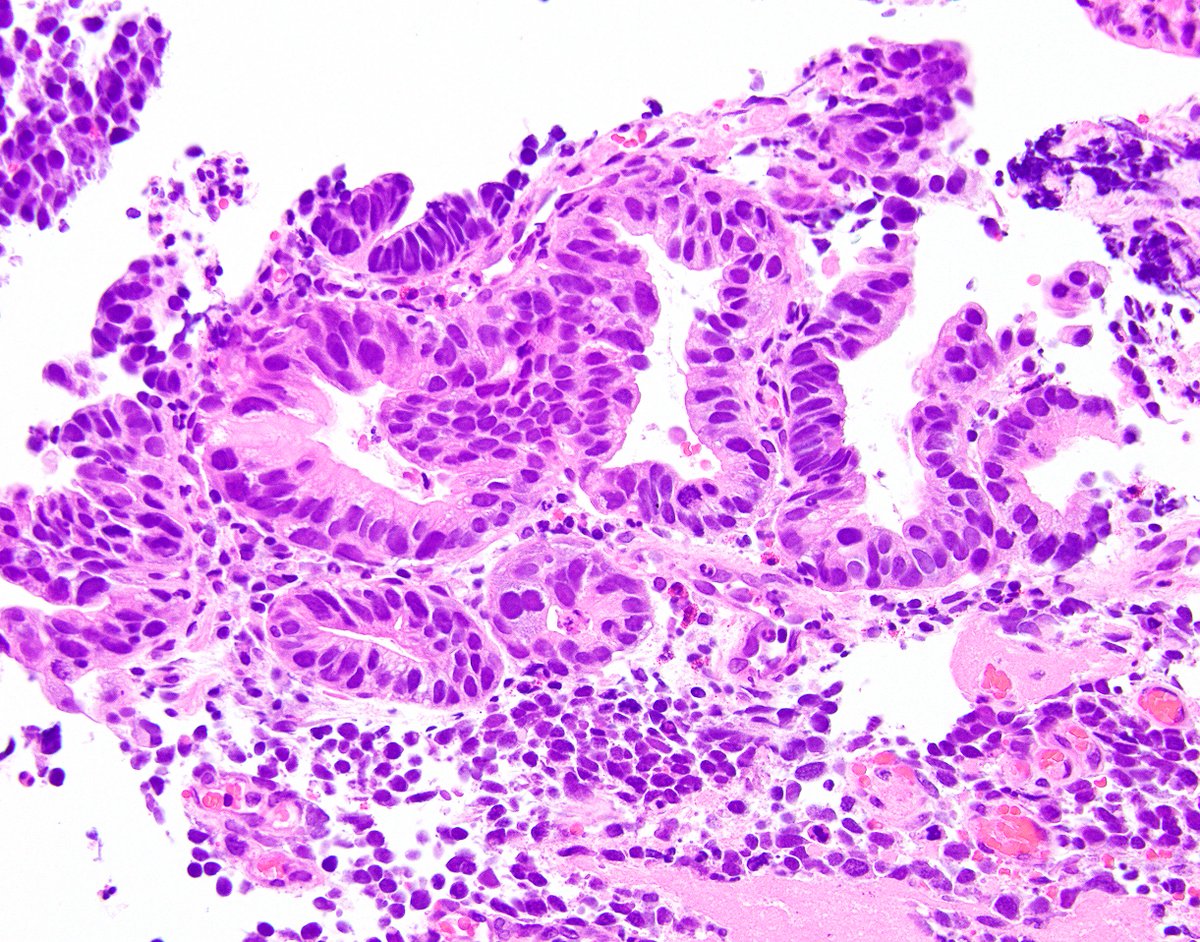 ARP Press on Twitter "Esophageal high grade