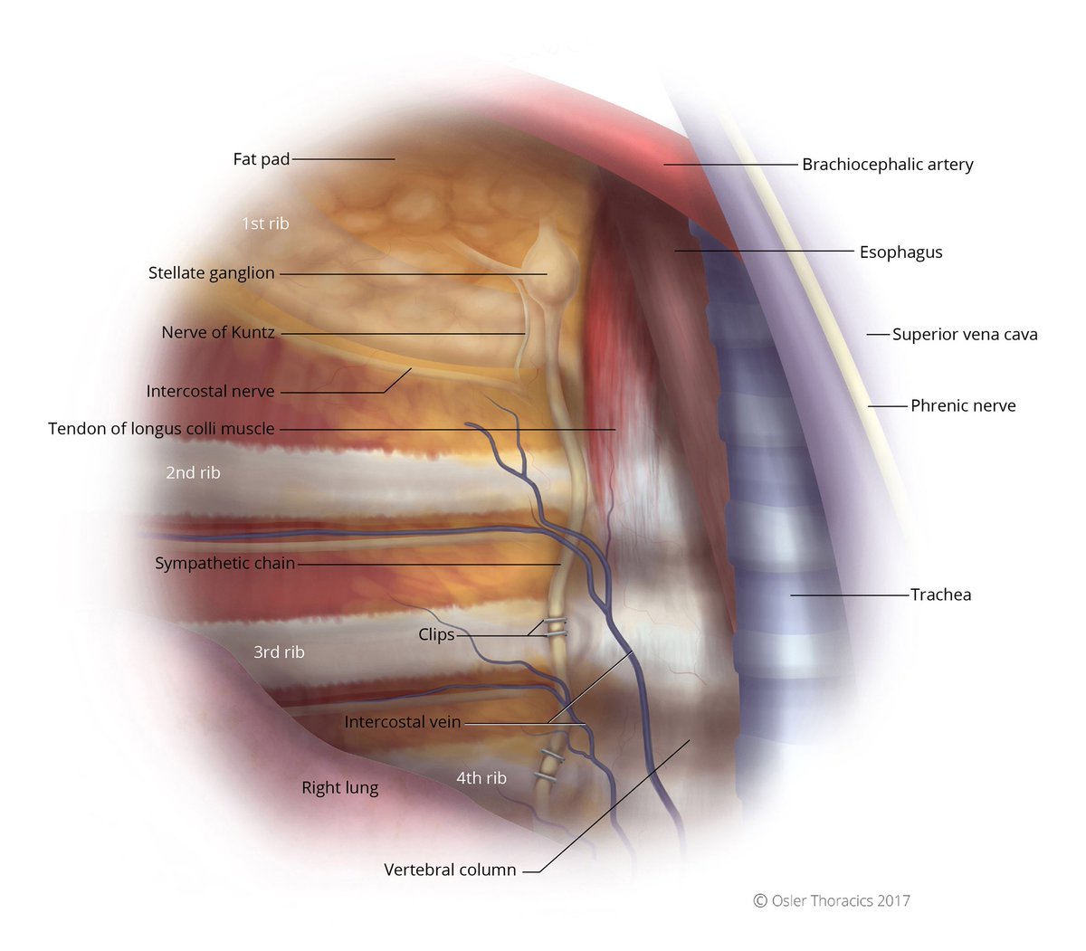 TorontoSweatCli's tweet photo. Anatomy of a sympathetic nerve clipping for hyperhidrosis #ets #sympathectomy #sweatypalms #SweatyArmpits #miradry #thoracicsurgery https://t.co/Yf4RfDvywc