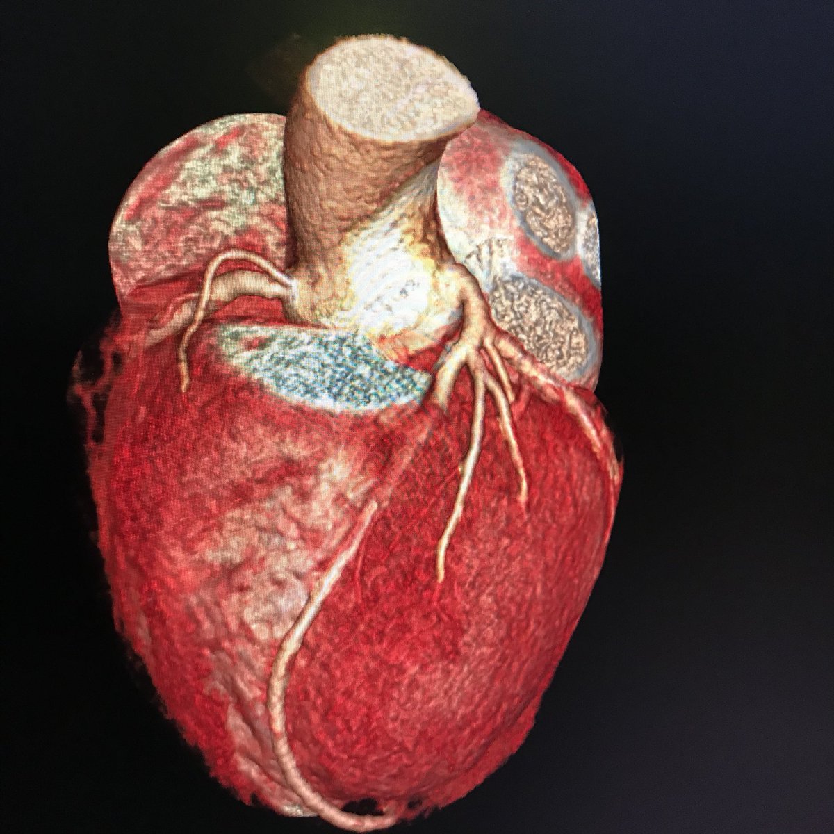 jedicath's tweet photo. Have seen this on angiography. Different when seen on CCT curtsy of @mirvatalasnag https://t.co/cCAHmoqfEh