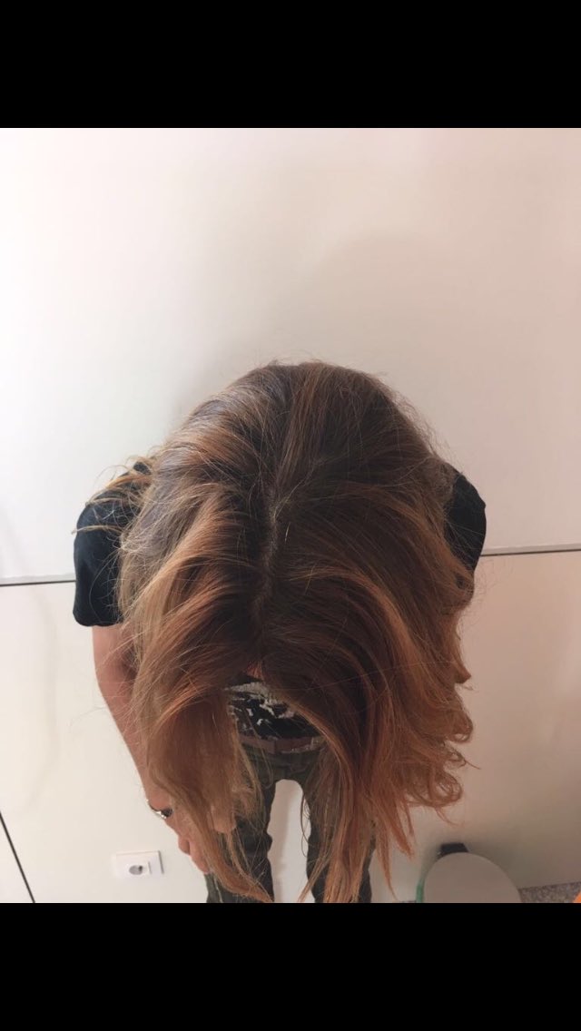 oncoalopex's tweet photo. Hoy es un día muy feliz!!Hemos conseguido ayudar a nuestra cliente y amiga Raquel a conservar su bonito y preciado pelo, después de 12 sesiones semanales de químio!! Gracias Raquel por tu simpatía, fuerza, coraje y alegría!! Oncoalopex!! Desmelénate!! #cáncer #caída #pelo #salud https://t.co/CDJsAs78DP