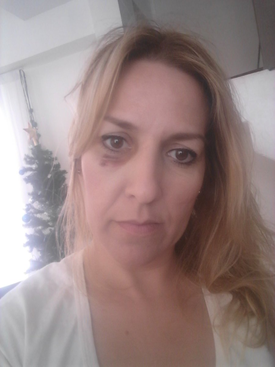 Agradezco  las manifestaciones de solidaridad hacia mi pero aclaro: NO fui agredida por manifestantes. Recibí una bala de goma cerca del ojo