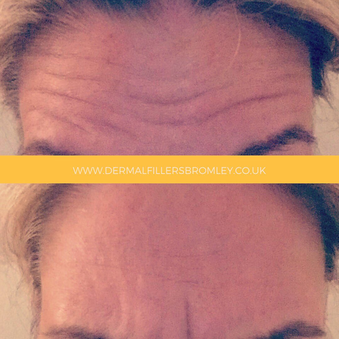 DermaFillersBR1's tweet photo. Another happy client who’s going to look amazing on #Christmas Day thanks to our anti-wrinkle injections.
https://t.co/x3Imqk31nd

#botox #beauty #fillers #nonsurgical #bromley #chislehurst #orpington #kent #london https://t.co/RFBvIfxVgF