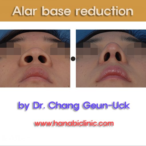hanabiclinic's tweet photo. Hanabi’s alar base reduction - Alar base reduction is used when the size of the nostrils are disproportionally enlarged relative to the nasal tip and also the position of the eye. More information-> https://t.co/Cw5gUz40kQ   #alarbasereduction #alarreduction #rhinoplasty #nosejob https://t.co/OFtz3ORhAx