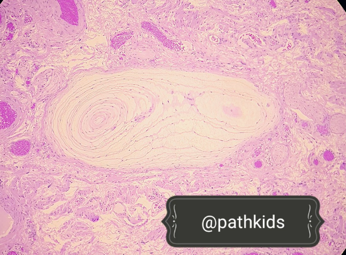 pathkids's tweet photo. A lovely #paciniancorpuscle from the foreskin. #GUpath #Microscopy #histology #circumcision https://t.co/LAEFXuNJq2