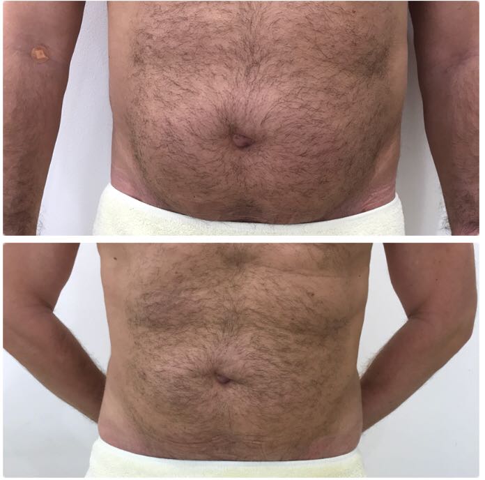 drbasemalhalabi's tweet photo. check the amazing results of our patient, after only 2 months of this unique #Lipo #laser procedure, which sculpts the body, removes fat, as well as tightening the skin. This procedure is painless, and is administered under local #aesthetic. https://t.co/WcEUdnUqQ2