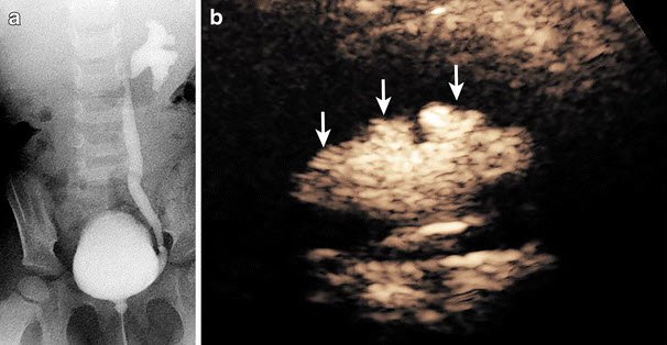 Online now:
In prospective study, #contrast enhanced voiding #urosonography (#ceVUS) 92% sens and 98% spec vs. #fluoroscopic #VCUG for detection of vesicoureteral reflux in #children.
82% concordance between exams
ow.ly/DRO830hi6W3
#PedsRad