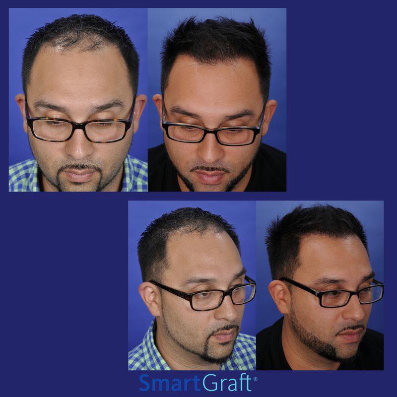 skinmedequip's tweet photo. Many people search for a permanent solution to hair and #SmartGraft is a smarter option without surgery, for both men and women. In these #beforeandafter photos we can see patients with fuller, thicker hair. You can rent this and other equipments with us! https://t.co/P1M8ExT6mG https://t.co/Nzl9RKLWhk