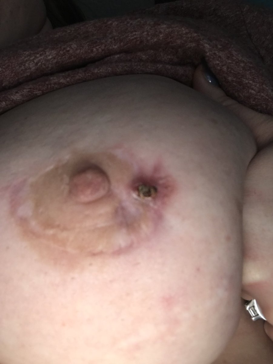 ashybaabyyy's tweet photo. Why won’t it heal?! Why? What the fuck is wrong with me? Surgery was August 10th. It shouldn’t be still opening up. #fuckcancer #thisistheaftermath https://t.co/LabsoVubA1