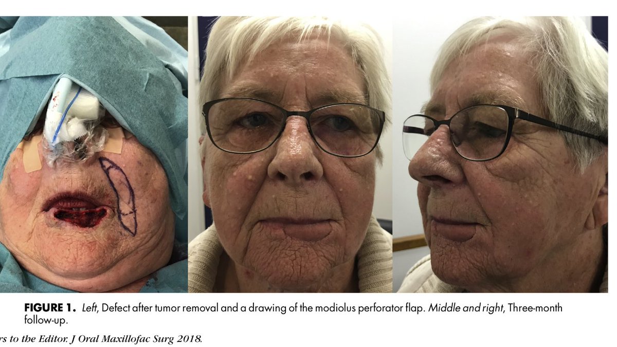 The Versatile Modiolus Perforator #plasticsurgery