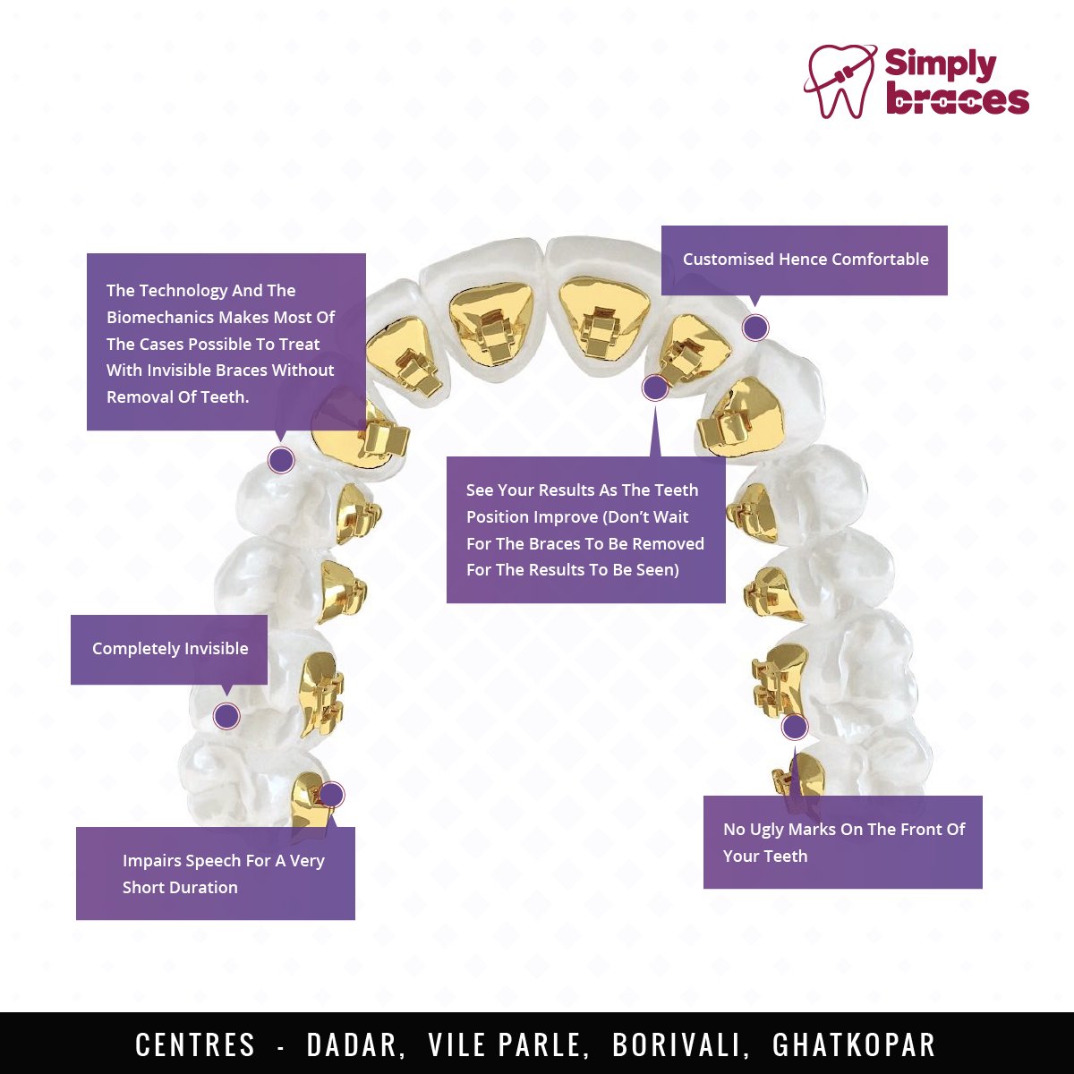 simplybracesIN's tweet photo. Our Lingual Braces allow your teeth to be.
#SBFacts https://t.co/VGSwnJBrhh