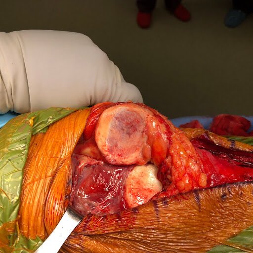 CzarneckiMD's tweet photo. Multiple patellar dislocations caused extensive cartilage damage. Matrix autologous chondrocyte implantation MACI restores native cartilage #chondraldefect https://t.co/vAeGH1Uove
