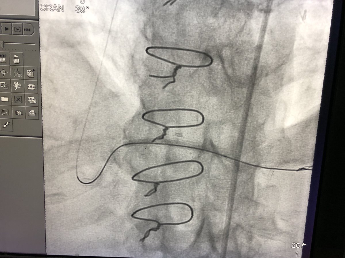 drkeyurparikh's tweet photo. Only open RCA SVG after 2 redo CABG in a 80 y/o patient with severe angina and occluded distal RCA CTO instent restenosis , opened using 3 Drug(Sirolimus) eluting balloons (Magictouch) through the SVG #instent #CTO #closedbypass @patelapurva @rooshaparikh https://t.co/CZ65b1z6W4