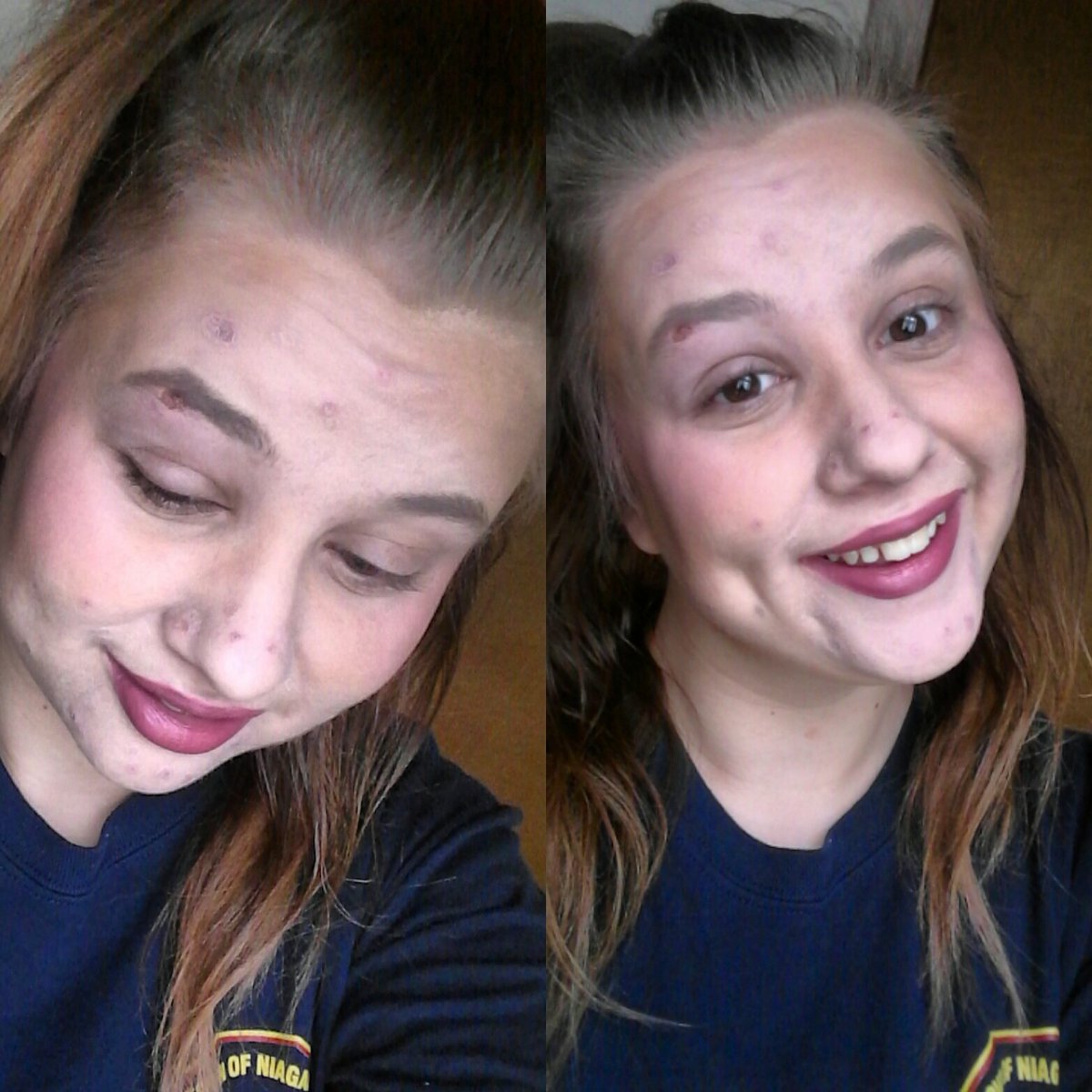 ambersoftball05's tweet photo. After about 5 days my infection from the bug bit on my eyebrow is finally going away, with the help of antibotics ha https://t.co/mv8Thmqdmf