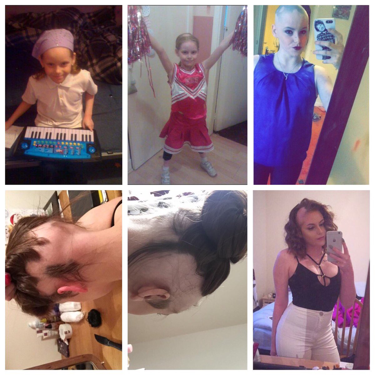 AleaCarr_'s tweet photo. I cannot believe it has been exactly 10 years since I found my very first ever bald patch. The fact I’ve lived more than half my life without all my hair makes me proud of myself for being so strong. I may never find a way to deal with alopecia but I’ll always keep trying 👶🏻💙 https://t.co/T2S1a62EUN
